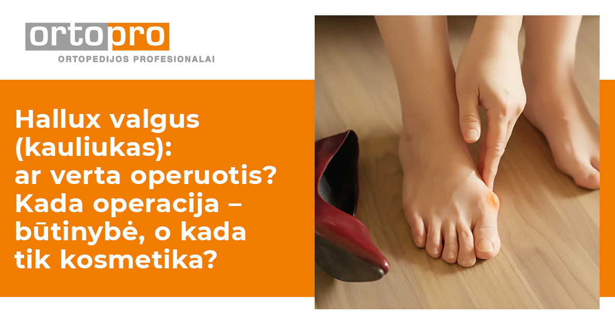 Hallux valgus (kauliukas): ar verta operuotis? Kada operacija – būtinybė, o kada tik kosmetika?