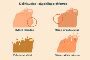 Dažniausios kojos pirštų deformacijos, kurias padeda mažinti geliniai tarpupirščiai: hallux valgus, plaktukiniai pirštai ir pirštų persidengimas